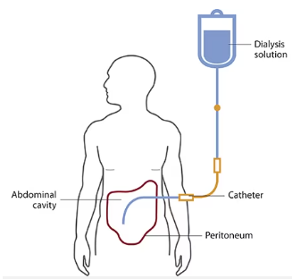 Dialysis Diagram