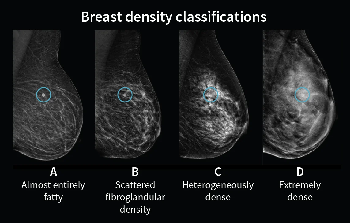 Breast Density Classifications